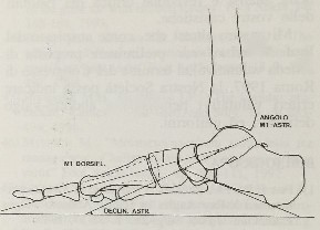 Profilo di un  piede con eccesso di pronazione e valgismo dell' alluce