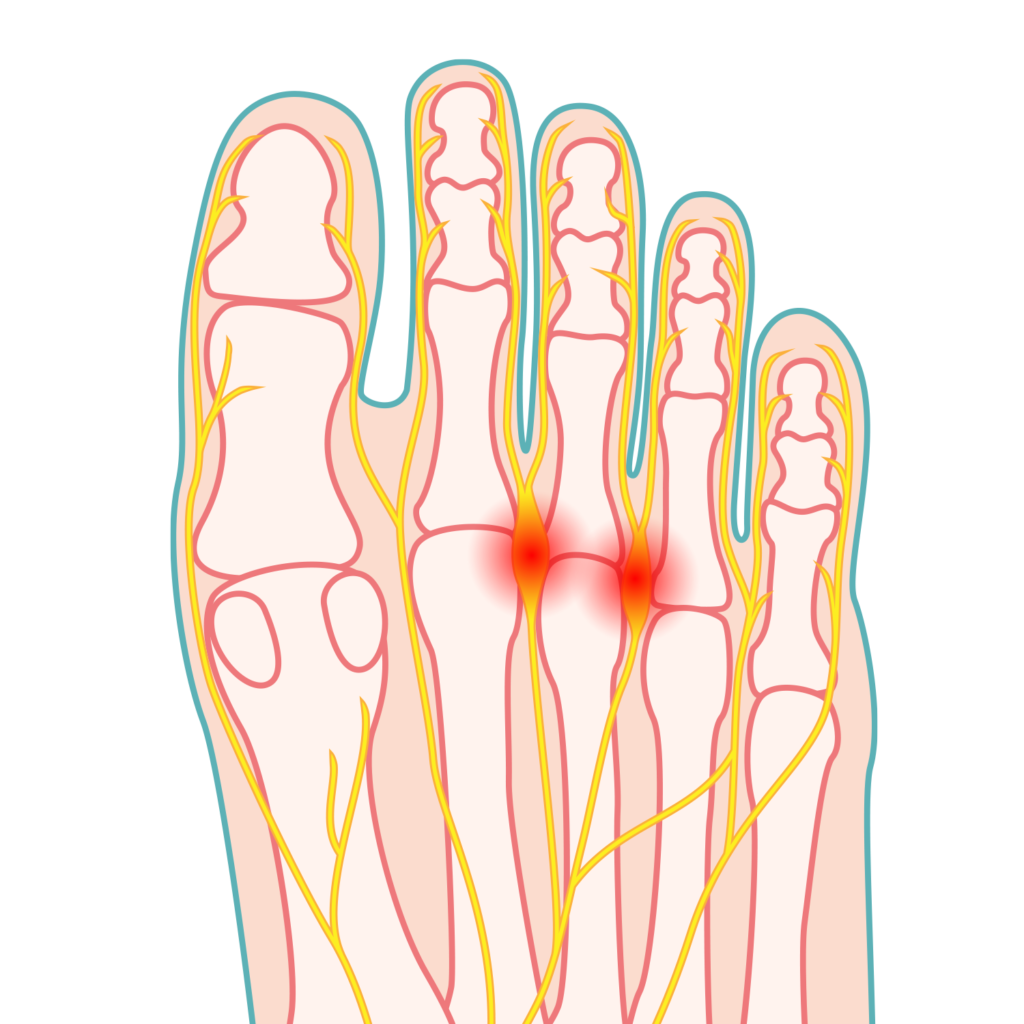 Neuroma di Morton: trattamento conservativo