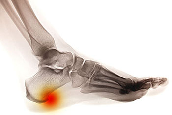 Sperone calcaneare: terapia podologica